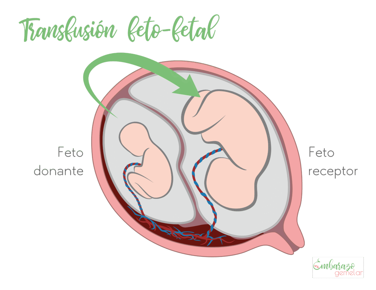 síindrome de transfusión feto fetal embarazo gemelar